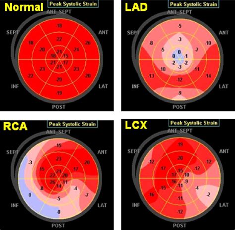 Non Doppler Two Dimensional Strain Imaging By Echocardiographyfrom