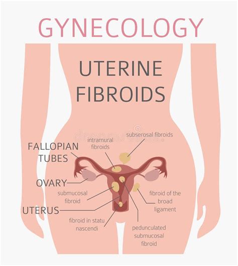 Uterine Fibroids Ginecological Medical Desease In Women Infographic