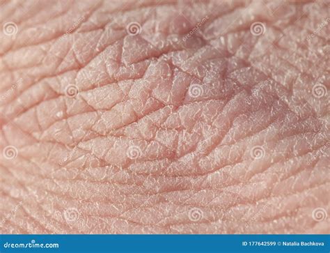 Texture Of Pink Weather Beaten Human Hand Skin Covered With Deep