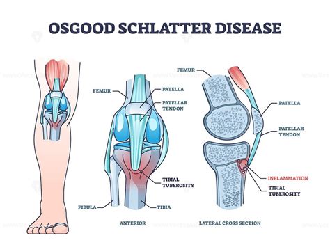 Osgood schlatter disease condition with knee joint pain outline diagram ...