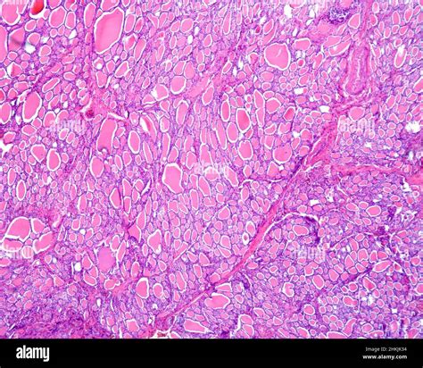 Follicular Adenoma Light Micrograph Stock Photo Alamy