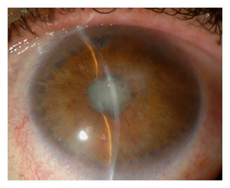 Iris bombé and pupillary seclusion in a patient with UG Peripheral