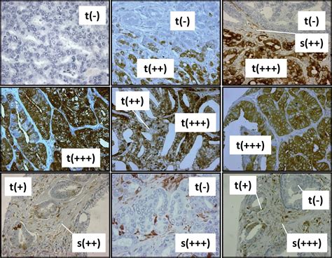 Aldh1 Positive Intratumoral Stromal Cells Indicate Differentiated