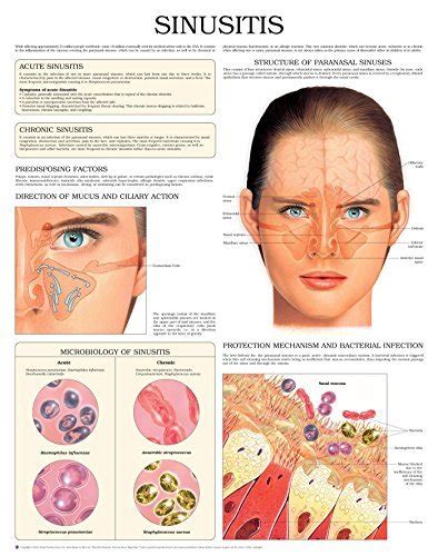 Sinusitis e chart: Full illustrated by HC-HealthComm | Goodreads