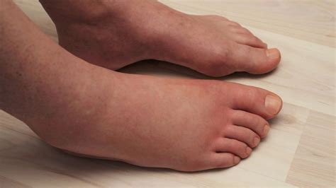 Scientists Explain 6 Things That Cause Swollen Legs (And How to Treat It)