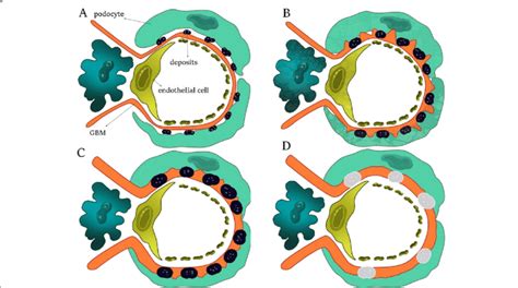 The Progression Of Mgn A Stage Ι B Stage ΙΙ C Stage ΙΙΙ D Download Scientific