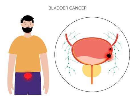 Bladder Cancer in Men – Health Journal