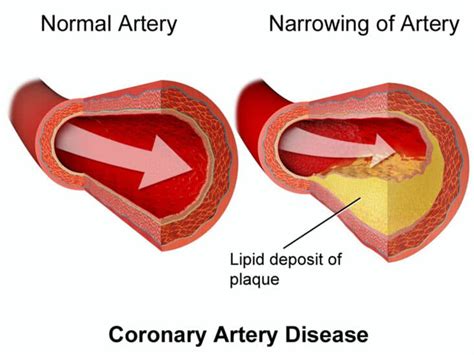 Understanding Atherosclerosis Symptoms And Management