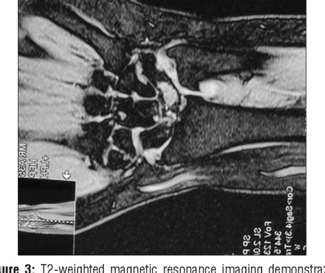 Figure 3 From Concomitant Avascular Necrosis Of The Lunate And Proximal