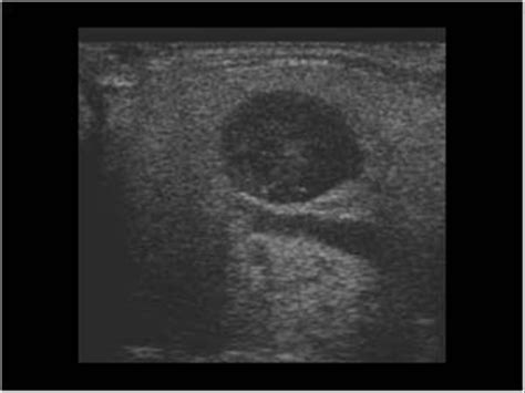 Parotid Gland Tumor Ultrasound