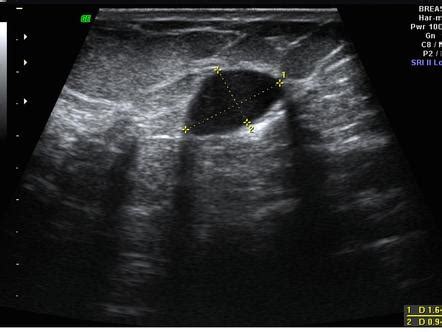 Breast imaging-reporting and data system (BI-RADS) | Radiology Reference Article | Radiopaedia.org