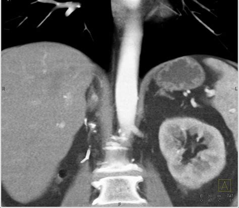 Cm Metastases To The Right Adrenal Gland From Renal Cell Carcinoma