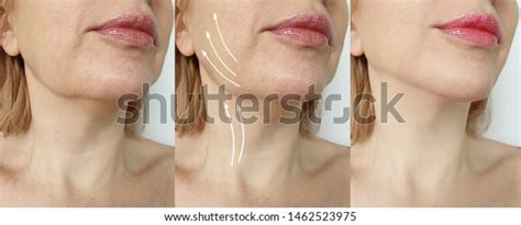 Woman Double Chin Before After Treatment Stock Photo (Edit Now) 1462523975