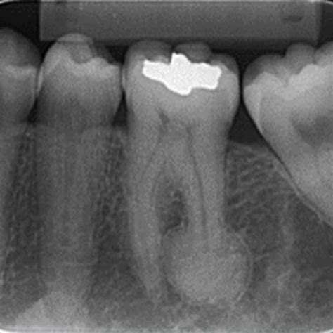 Pdf Hypercementosis Diagnostic Imaging By Radiograph Cone Beam