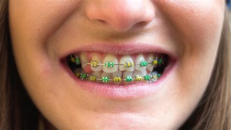 ϡ Brackets de Colores Tipos Combinaciones y cuáles elegir