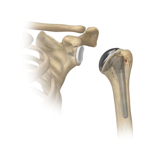 Anatomic Vs Reverse Shoulder Replacements What Are The Differences