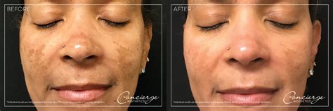 The Perfect Derma Peel Irvine Concierge Aesthetics Orange County