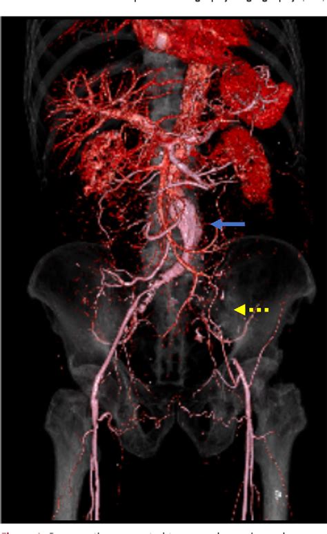 Figure From Minimally Invasive Two Stage Procedure Of Aorto Bi Iliac