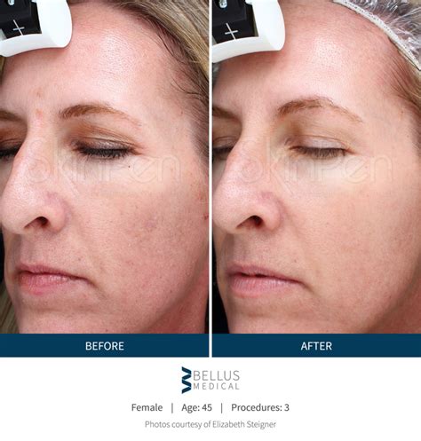 Microneedling Wink Medical Aesthetics Wink Medical Aesthetics