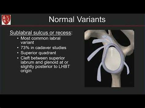 Imaging of the Glenoid Labrum: Location Matters! By Michelle Nguyen, MD ...