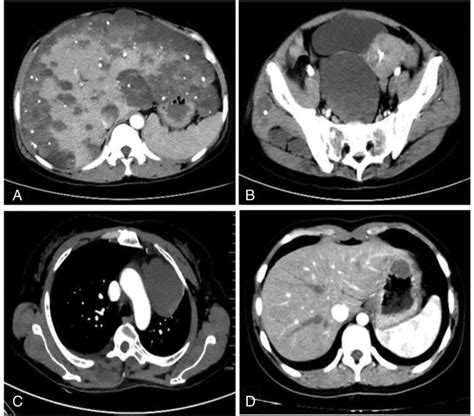 Abdomen Ct Scan With Intravenous Contrast Administration Revealed Download Scientific Diagram