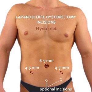 Laparoscopic Hysterectomy: Total Laparoscopic, Robotic, Vaginally ...