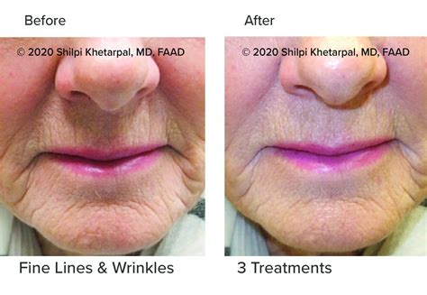 Microneedling With Prp Colorado Dermatology Mohs Surgery