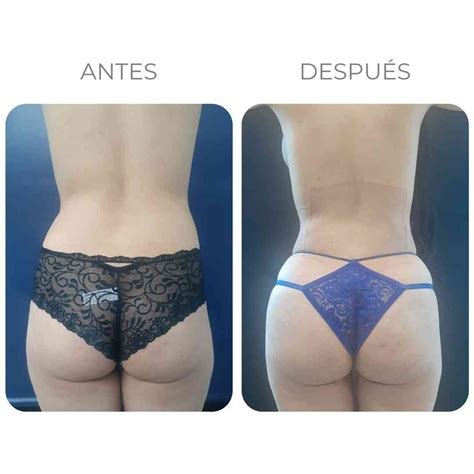 Lipotransferencia Gl Tea Dr Ricardo Becerra