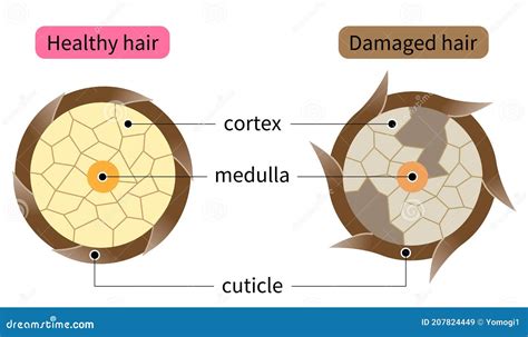 Damaged Cuticle Layer Cause Damaged Hair Cartoon Vector | CartoonDealer ...