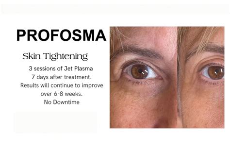 Profosma Jet Plasma Skinrx Aesthetic Clinic Pty Ltd