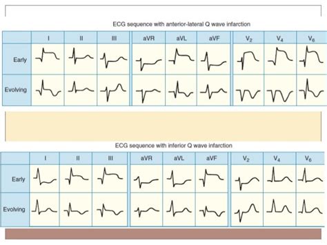 Basic Ecg Diagnosis