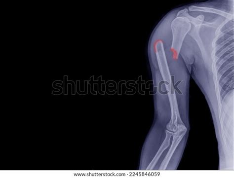 Forearm Xray Showing Fracture Upper Arm Stock Photo 2245846059 | Shutterstock