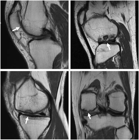 Synthetic Biphasic Scaffolds Versus Microfracture For Articular