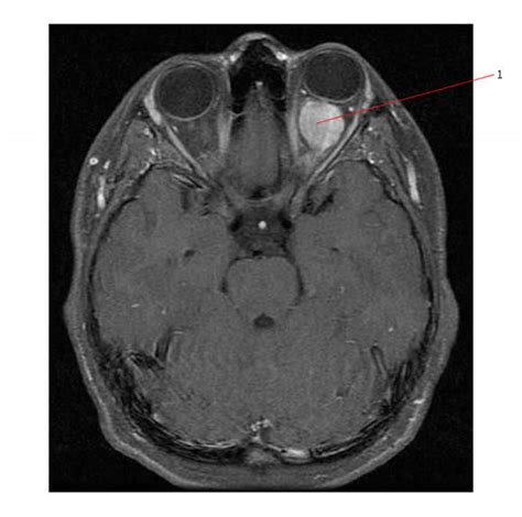 Glioma: Optic Nerve Glioma