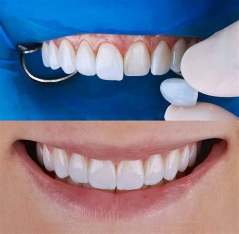 Faccette Dentali Cosa Sono A Cosa Servono Vantaggi E Alternative