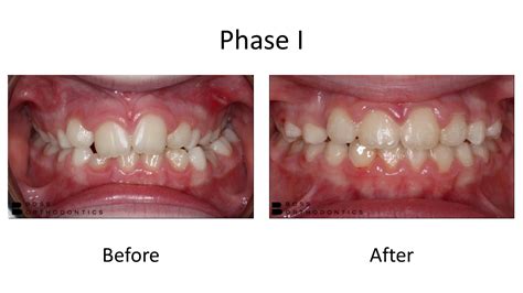 Phase I Before And After Transformation Crossbite Correction Boss Orthodontics