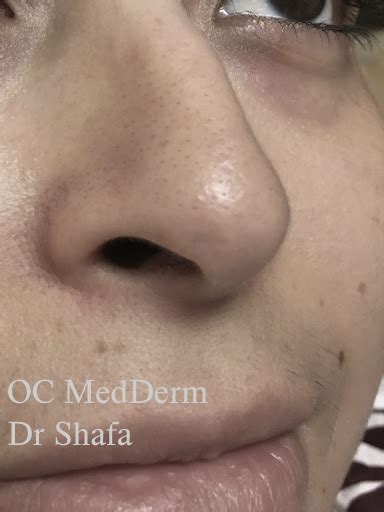 Skin Biopsy Procedure At Oc Medderm Irvine And Orange County Dermatology