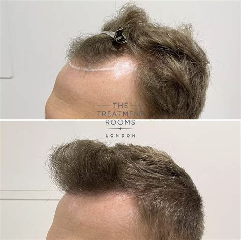 Fue Hair Transplant 1346 Grafts Treatment Rooms London