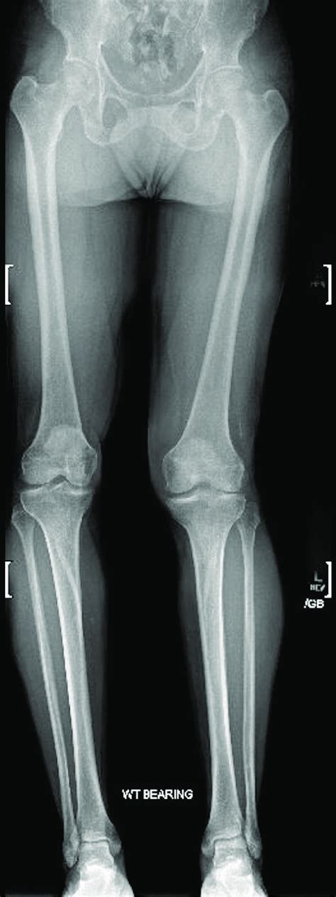 Anteroposterior AP Weight Bearing WT Bearing Plain Film Radiograph