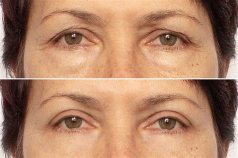 What Does Recovery Look Like After Ptosis Surgery Taban Md