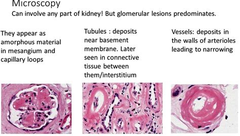 AMYLOIDOSIS: PART 3: Morphology, Diagnosis, Special stains, clinical ...