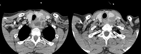 Computed Tomography Scans Of The Lower Neck Right And Upper Download Scientific Diagram