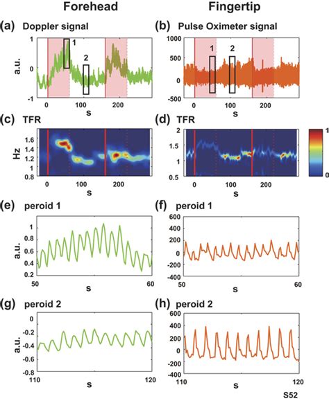 Typical Examples Of Pulsatile Components Of Doppler Signals On The