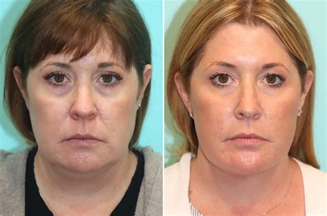 Chin Facial Implant Facelift Fat Transfer Photos Chevy Chase Md