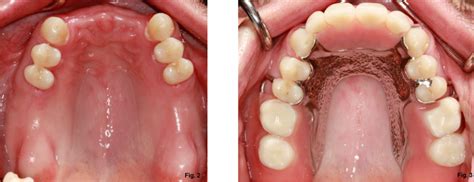 How Should A Case Like This Be Treated Partial Dentures Dental