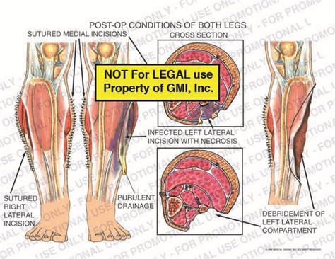 Post Op Conditions Of Both Legs 98157c35a Generic Medical Legal Exhibits A Division Of Mvi