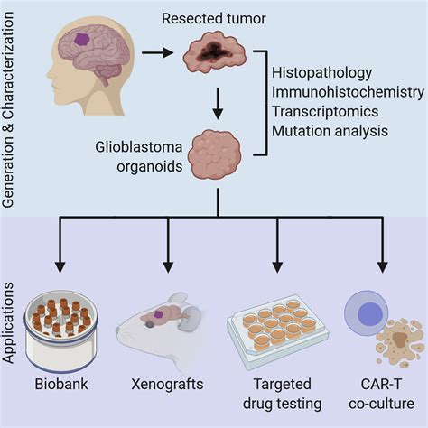 A Patient Derived Glioblastoma Organoid Model And Biobank Recapitulates