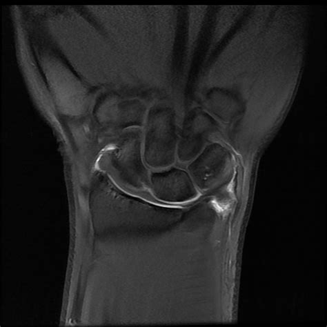 Ulnar Collateral Ligament Wrist Mri