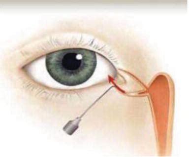 Endoscopic Dacryocystorhinostomy Intechopen