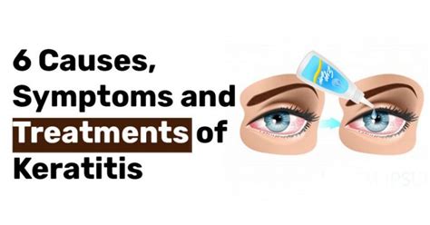 6 Causes, Symptoms, and Treatment of Keratitis | HealthyTed